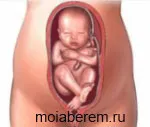 пологи при тазовому передлежанні