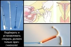 спіралі від вагітності