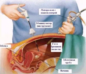 позаматкова вагітність операція