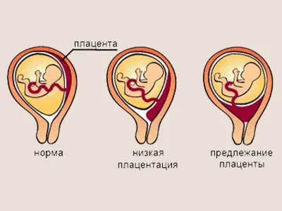 9 тиждень вагітності коричневі виділення
