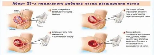 завмерла вагітність симптоми