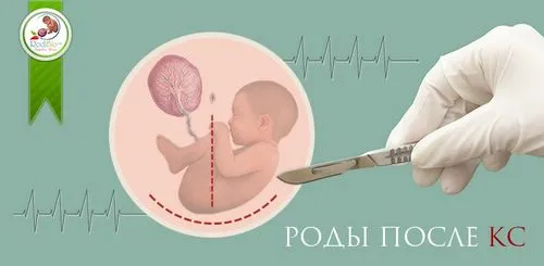 вагінальні пологи після кесаревого розтину