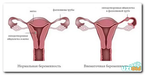 на якому тижні можна виявити позаматкову вагітність