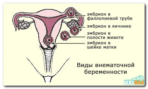 на якому тижні можна виявити позаматкову вагітність