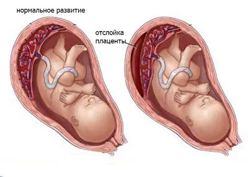 товщина плаценти на 32 тижні вагітності