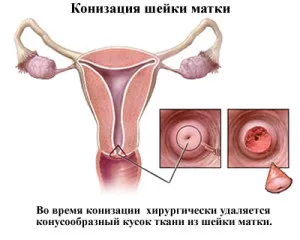 чи можна завагітніти при дисплазії шийки матки