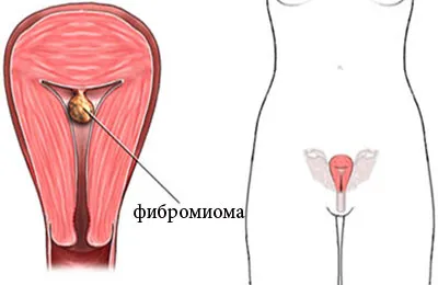 фіброміома матки при вагітності