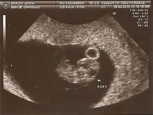 болі на 8 тижні