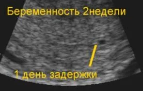 ранні ознаки вагітності на першому тижні: які відчуття можуть з'явитися у жінки