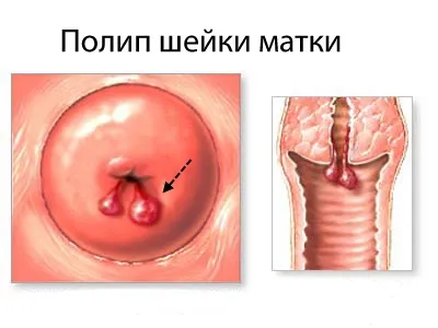 поліпи на шийці матки під час вагітності