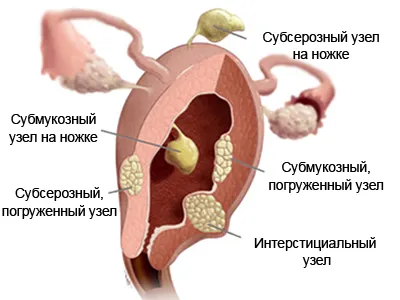 міома матки при вагітності