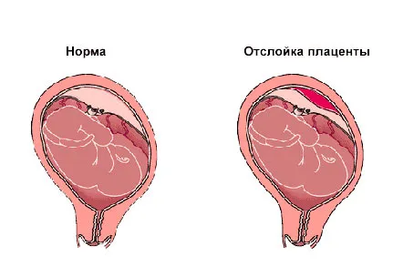 виділення при вагітності коричневого кольору
