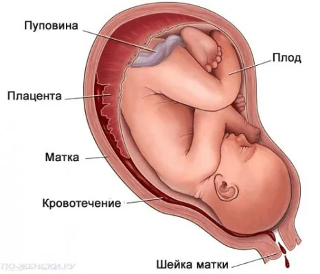 міома матки при вагітності