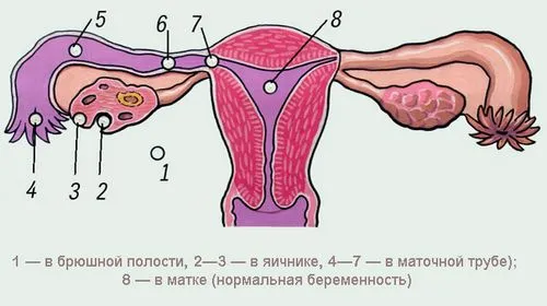 порушена позаматкова вагітність симптоми порушена позаматкова вагітність симптоми