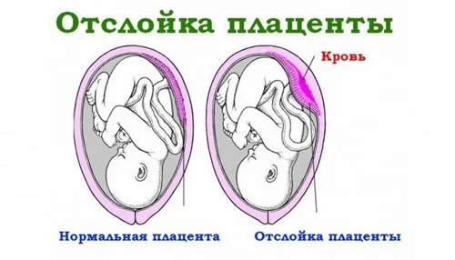 30 тиждень вагітності твердий живіт