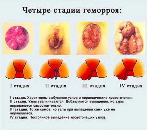 як лікувати геморой при вагітності