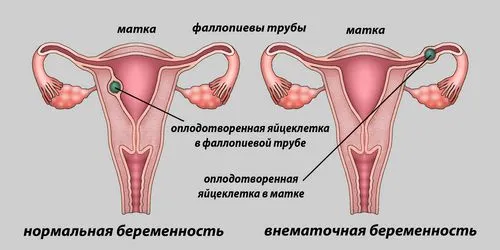позаматкова вагітність симптоми