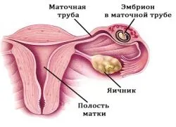 як уникнути позаматкової вагітності