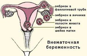 як дізнатися позаматкову вагітність