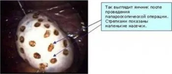 яєчників, вагітність, полікістоз, завагітніти, можна, захворювання, які, буде, може, вагітності, жінці, впоратися, лікування, полікістозу, час, після, швидше жінці