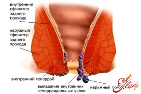 як позбутися від геморою під час вагітності