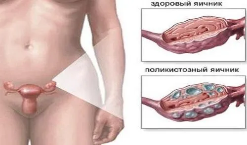 яєчників, вагітність, полікістоз, завагітніти, можна, захворювання, які, буде, може, вагітності, жінці, впоратися, лікування, полікістозу, час, після, швидше вагітності