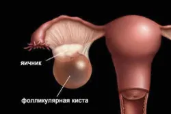 фолікулярна кіста яєчника вагітність