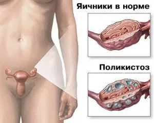 можливість завагітніти при поликистозе