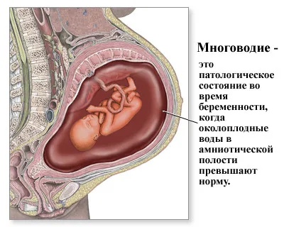 помірне багатоводдя при вагітності