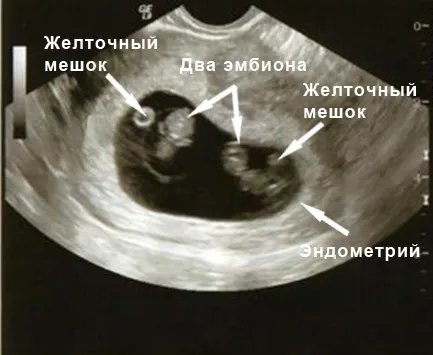 вагітність 9 тиждень