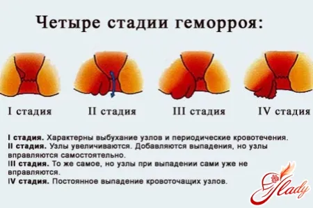 геморой при вагітності симптоми