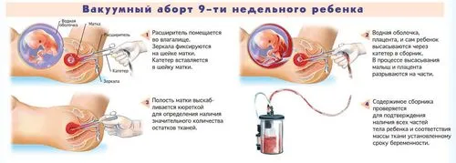 вагітність 7 тижнів аборт, здоров'я мами здоров'я мами