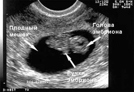 узі 9 тижнів вагітності фото як відчувати себе малюк
