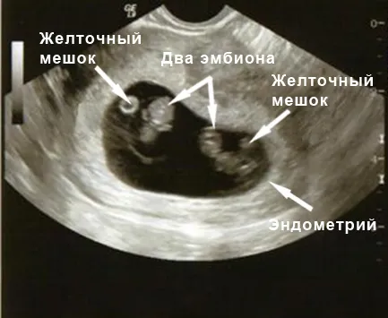 узі 9 тижнів вагітності фото як відчувати себе малюк