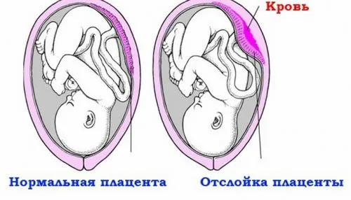 рожеві виділення у вагітних
