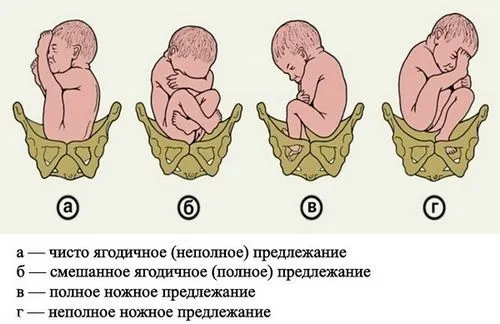 вагітність і пологи при тазовому передлежанні