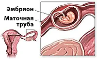 що таке позаматкова вагітність