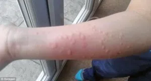 метеоаллергія