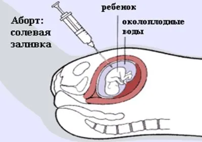 аборт штучне переривання вагітності
