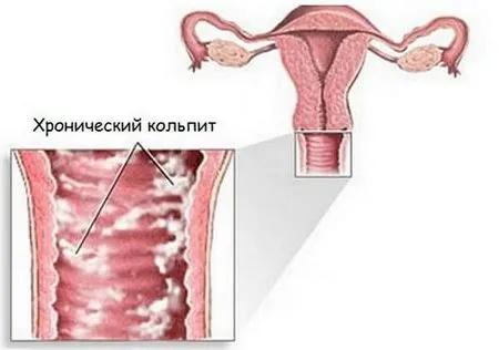 неприємний запах піхву причини симптоми ускладнення діагностика лікування народні засоби пологи бактерії