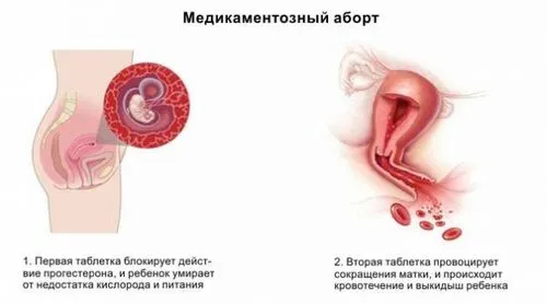 аборт штучне переривання вагітності