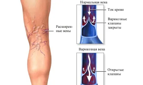 варикоз при вагітності лікування