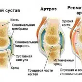 Артроз і бурсит: що спільного? як лікувати артрит бурсит