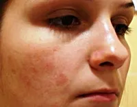 як лікувати алергію на цитрусові