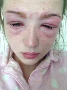 алергія