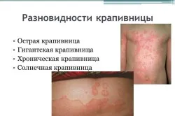 Алергія кропив'янка: причини, симптоми і лікування органи кровотворення