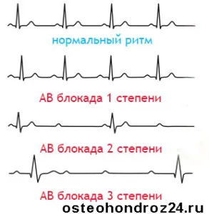 як лікувати аритмію і тахікардію