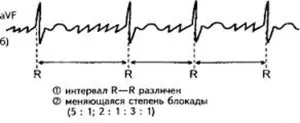 аритмія серця що робити як лікувати ліки препарати що приймати народні