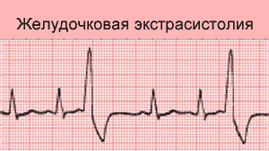 аритмія серця що робити як лікувати ліки препарати що приймати народні