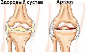 як лікувати артроз 1 ступеня